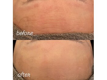 リノ(Lino)/おでこのシワも一度でふっくら！