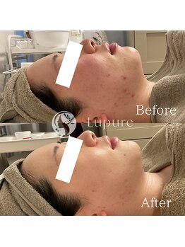 ルプレ(Lupure)/ハーブピーリング6回目