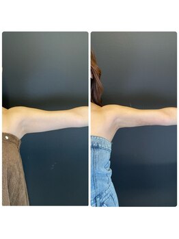 エステアンドヘアーサロン アルテ 札幌/二の腕のボコボコやダウンタイム