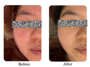 ラディアント たまプラーザ/乳酸ピーリング(スノーピール)