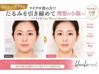 オリエンタルローザ 表参道(Oriental Rosa)の写真/ほうれい線&たるみ改善はマイクロ波リフト≪マイクロ波NEO WAVES blanche≫実感できる納得の引き締め小顔◎