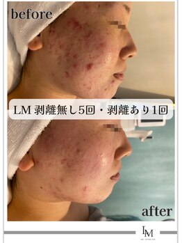 ライム 池袋東口(LIME)/Before&After　全顔