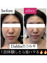 ダリア(Dahlia)/小顔コルギ