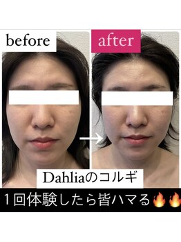 ダリア(Dahlia)/小顔コルギ