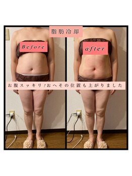 ティアメディカル(Tia Medical)/脂肪冷却