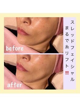 アールアンドエス(R&S)/スレッドフェイシャル