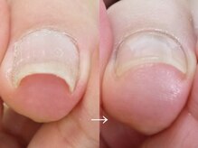 メイシンネイル(Meixingnail)/巻き爪矯正もおまかせください