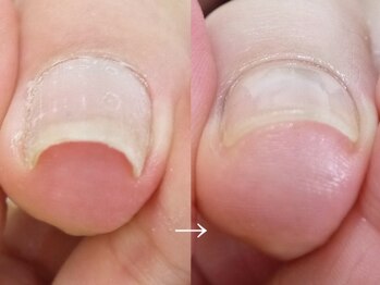 メイシンネイル(Meixingnail)/巻き爪矯正もおまかせください