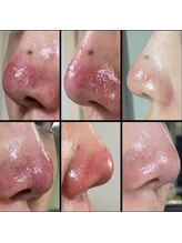 キュライム 熊本(CURAIM)/美肌管理 【30代女性】