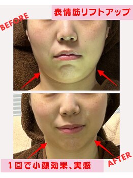 ユーフォリア(Euphoria)/フェイスラインのリフトアップ