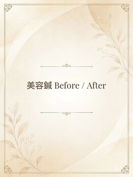 長寿鍼灸院 長寿整骨院/美容鍼の変化を実感。