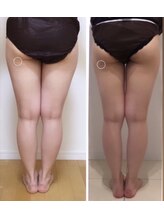 美人バスト 渋谷店/【痩身・ダイエット】 渋谷/脚☆