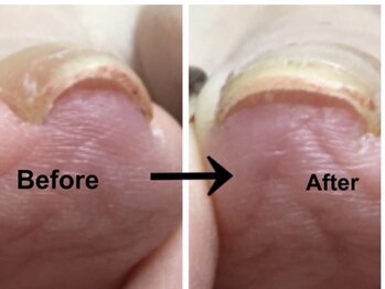 リーフ 海田店(LEAF)/メニュー:巻き爪矯正