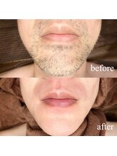 ユウユウ(YUYU)/ヒゲ脱毛　LED×WAX