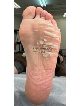 イチロクイチハチ(1618)/角質は臭いの原因