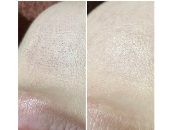 アンビジュ(un bijou)/気になる口周り(アゴ)