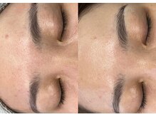 モガナ(mogana)/赤ちゃん肌ピーリング