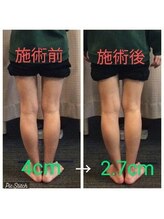 クシロ鍼灸整骨院/【O脚矯正】施術例