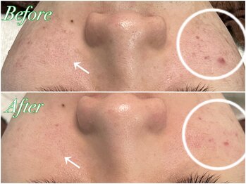 アンドナイン エス店(ANDNINE.)/ハーブピーリング