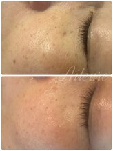 エルール トータルビューティ(Aileure total beauty)/シミくすみケア ララピール×Wax