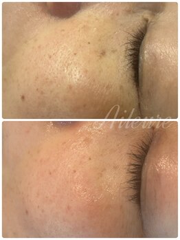 エルール トータルビューティ(Aileure total beauty)/シミくすみケア ララピール×Wax