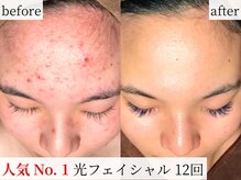 エステティックティアリィ サンマルシェ高蔵寺店(TiARY)の雰囲気（毛穴改善/毛穴ケア/ニキビ）