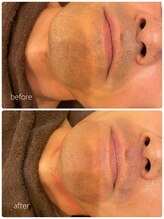 ダリオムズ 西宮北口(DAHLI HOMMES)/☆メンズヒゲ脱毛☆施術2回目