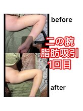 スマイルミー/術後　before-after