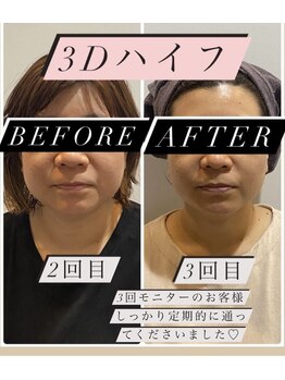 アンベール(unveil)/小顔