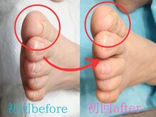 ドクターネイル爪革命 長野店/【巻き爪ケア】ネイル/フット