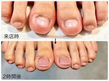 モアナ 池袋(MOANA)/フット人工爪改善（ワンカラ－）