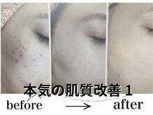 アルゴ 八幡黒崎店(ALGO)/本気の肌質改善1
