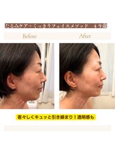 ルルドフォンテ(rurudo fonte.)/フェイスラインのもたつき解消！