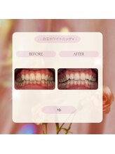 プラスビーセルフ(+b self)/ホワイトニングビフォーアフター