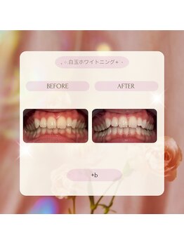 プラスビーセルフ(+b self)/ホワイトニングビフォーアフター