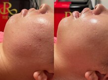 ゾーンビューティーハウス 柏店(ZONE BEAUTY HOUSE)/☆ブライダルケア☆