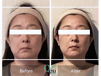 キュープ 練馬店(Qpu)/【オイルリンパ4回+首元ケア】