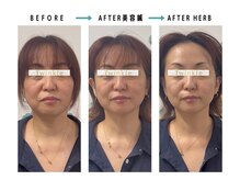 ティンクル(Twinkle)/むくみ・リフトアップ