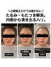 【たるみ/ハリツヤ/小顔特化型】小顔矯正との相性◎エイジングケアピーリング