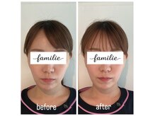 ファミリエ 大阪院(familie)/お顔の左右差・頬のたるみ