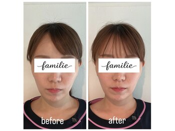 ファミリエ 大阪院(familie)/お顔の左右差・頬のたるみ