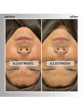 アガットバイミヤモト(agate by miyamoto)/イラストリアス（美白）施術1回