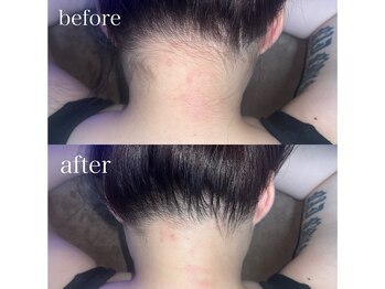 エピジュ(Epijyu)/女性のうなじ脱毛