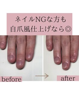 ティアラネイル(tiaranail)/再発させない深爪矯正