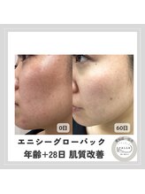 カラー(CALLA)/炭酸ガスパック☆