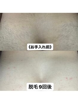 ミノア 大野城店(MINOA)/全身脱毛 9回ビフォ‐アフタ‐