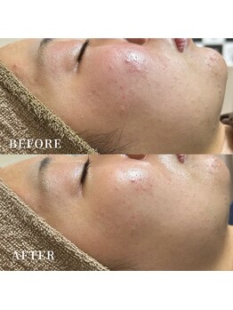 エース(ACE.)/頬の赤み・ニキビケア☆