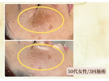 サロン カズリナ(Salon Kazrina)/ハーブピーリング