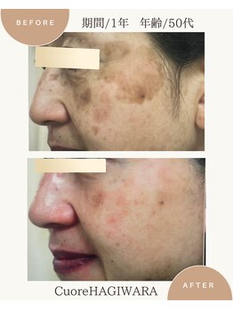 クオーレ ハギワラ(cuore HAGIWARA)/肌質改善/しみ・くすみ・たるみ