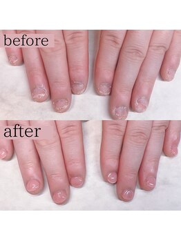 ティアラネイル 宇都宮/深爪矯正